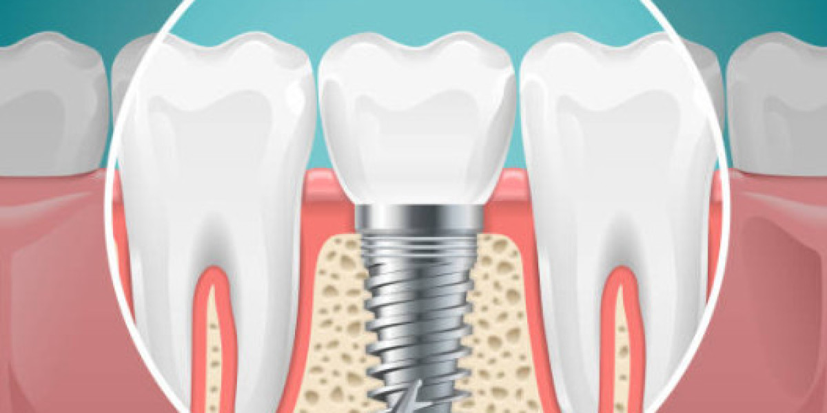 How Affordable Dental Implants in NYC Compare To Dentures