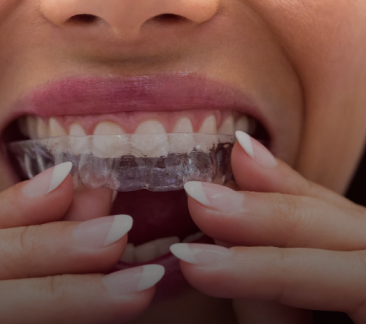 Invisalign Treatment North Carolina | Invisalign Retainer Replacement & Consultation | Invisible Dental Aligners