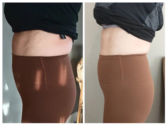 Body Contouring vs Weight Loss: Key Differences Explained | Insight Cryo