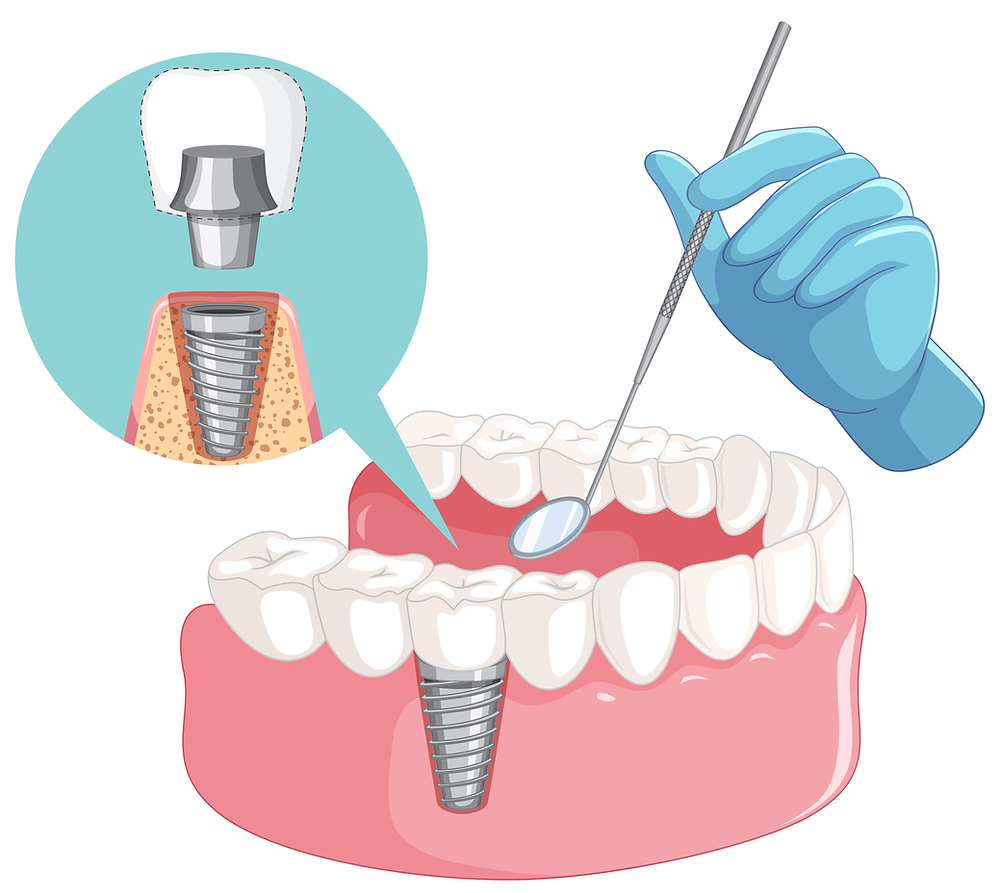How Do Dental Implants Work As A Tooth Replacement?