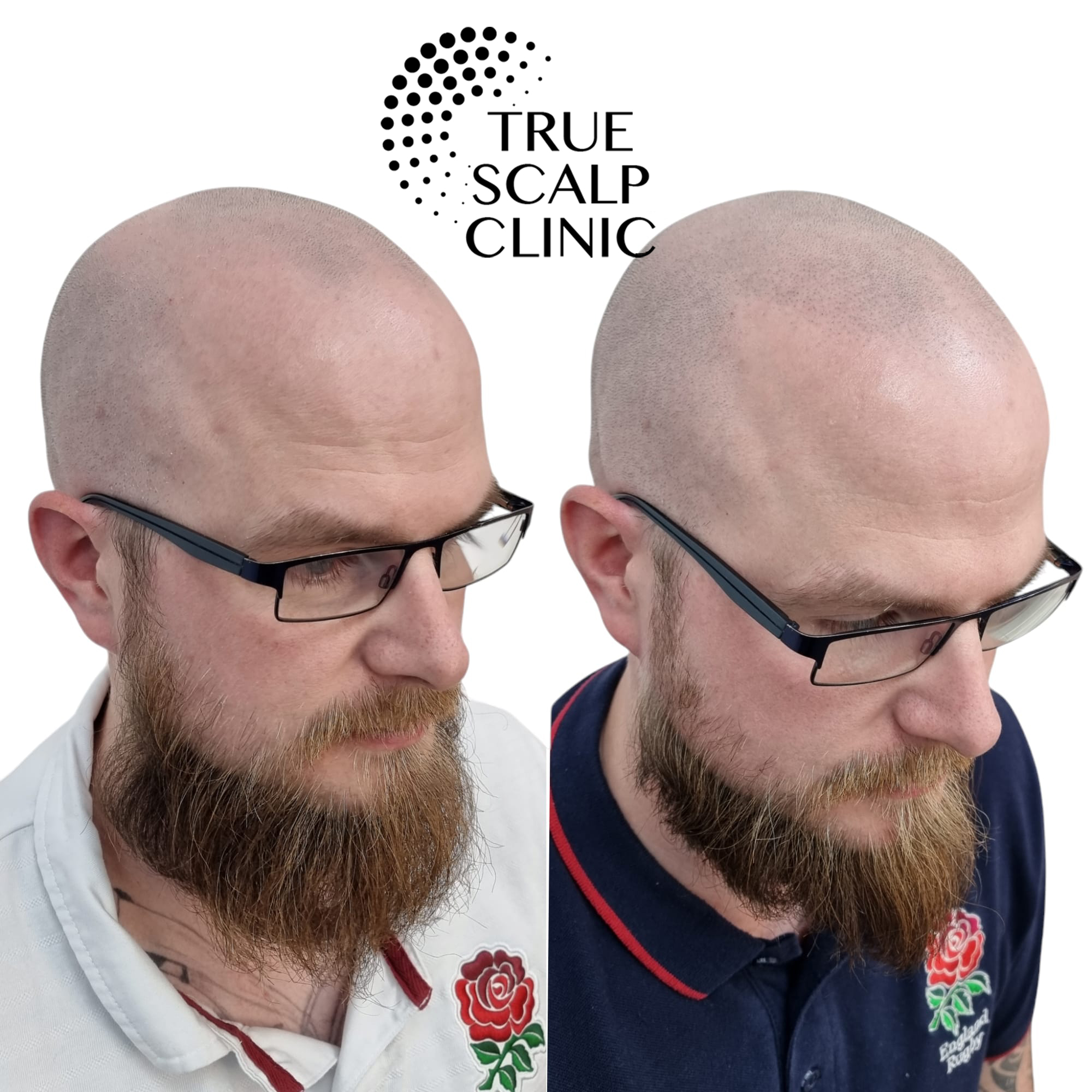 Best Scalp Micropigmentation in London | Call 07907953582