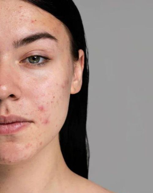 Acne Removal Treatment Costs Explained