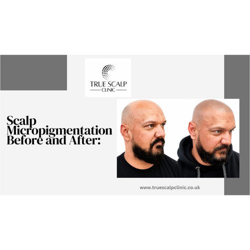 Scalp Micropigmentation Before and After: What Changes Can You Expect