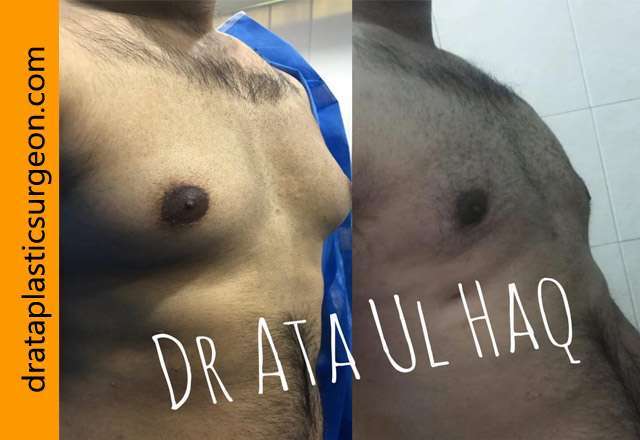 Gynecomastia Surgeon in Lahore, Pakistan | Dr Ata-ul-Haq
