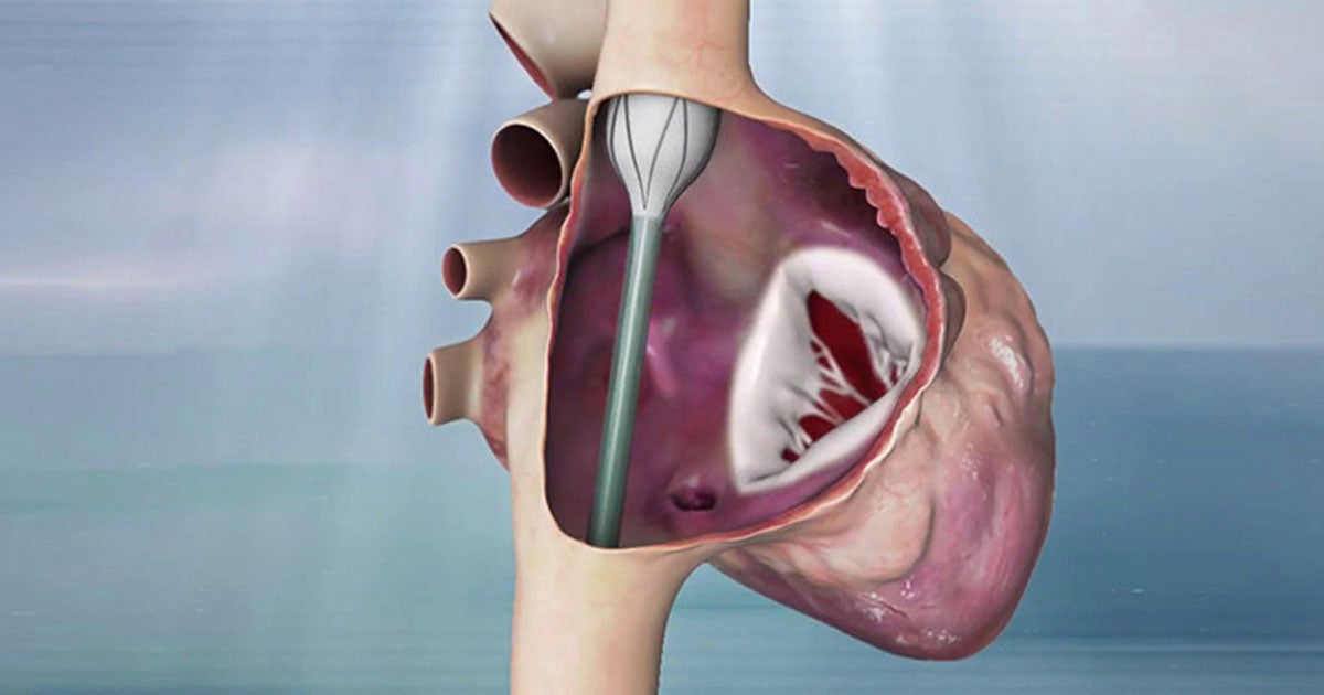 Transcatheter Tricuspid Valve Replacement | Dr. Ritesh K. Pandey