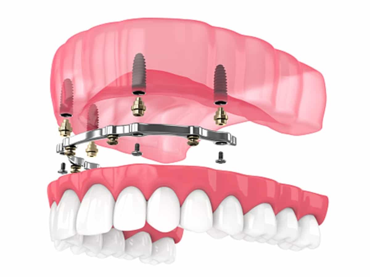 How Do Implant-Supported Restorations Stay Secure When You Eat and Speak? – Telegraph