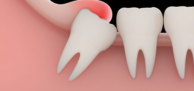 Are Wisdom Teeth A Problem? | Advanced Dental Care Clinic