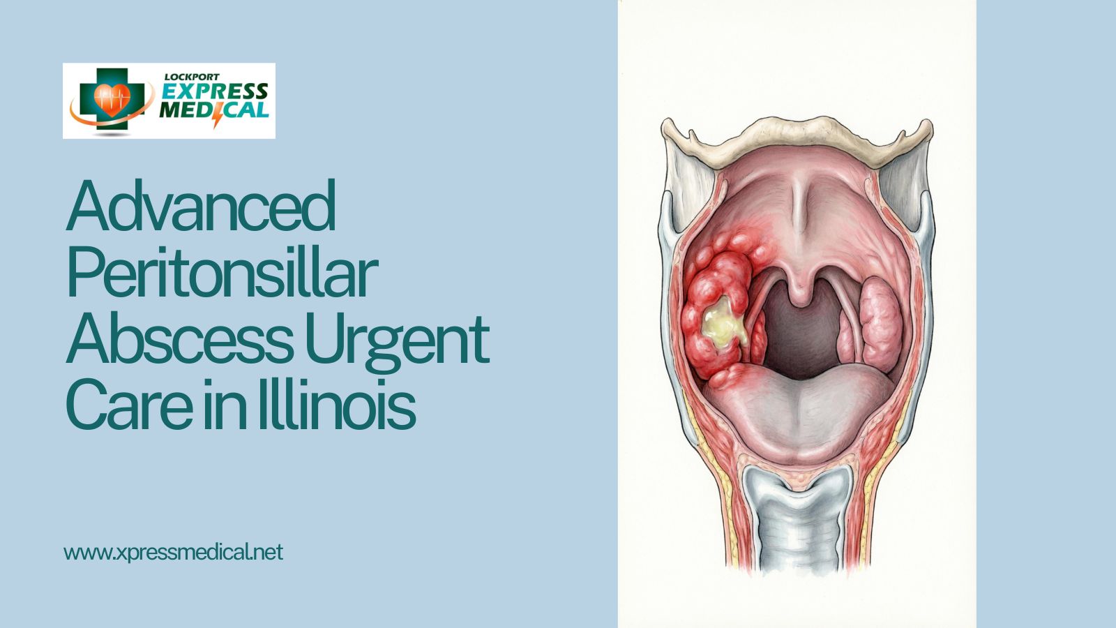 Peritonsillar Abscess Urgent Care in Lockport IL
