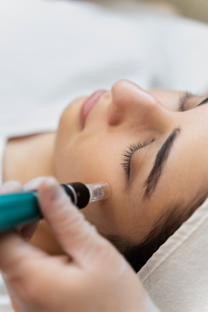 Microneedling: Benefits, Risks, and How It Works | The Facial Room LLC