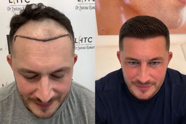 How to Prepare for Your First DHI Hair Clinic Consultation – @theskinandhairclinic on Tumblr