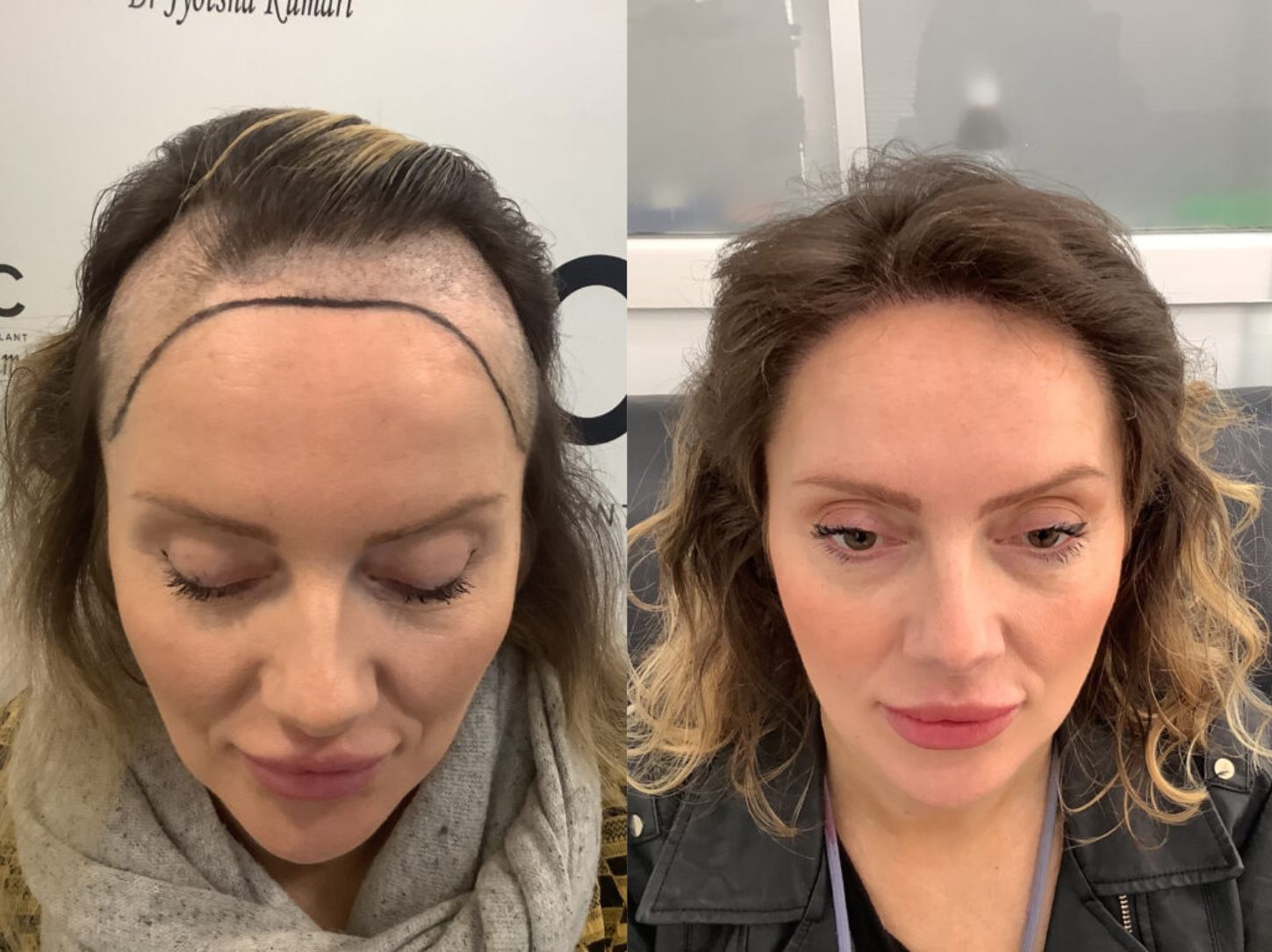 Rising demand for hair transplants in the Merseyside region | SubmitPR Free