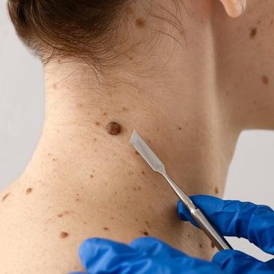 Mole Removal in Islamabad | Enfield Royal Clinics